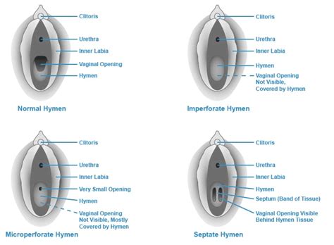 hymen video|This Video Explains What a Hymen Really Is